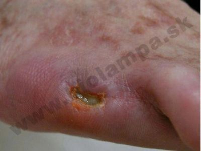 Cicatriz de amputación en un paciente diabético 