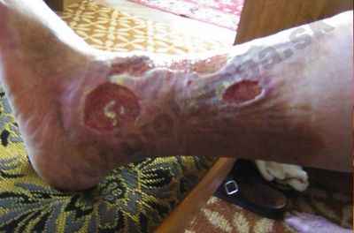 Úlceras de Bercus (úlceras de espinilla) 